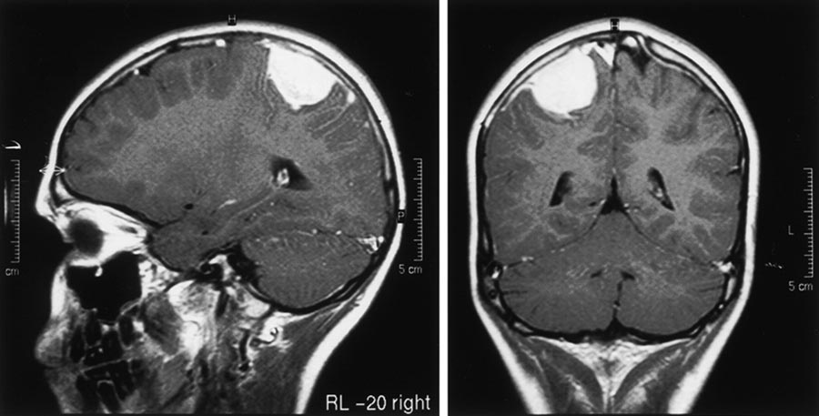 Meningioma Treatment Cost in India