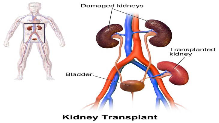 kidneys transplant surgery cost in india