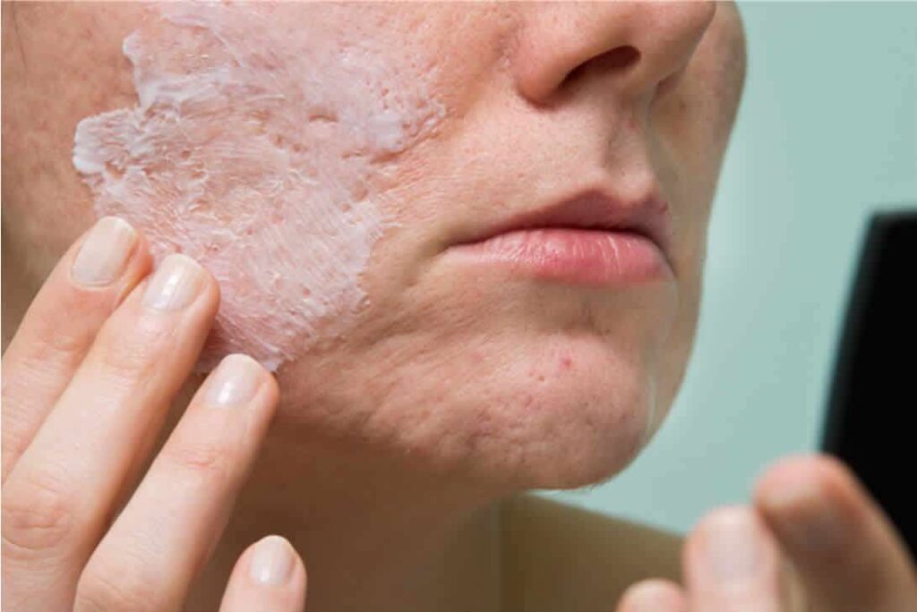 Ice Pick Scars – Causes, Symptoms & Treatment